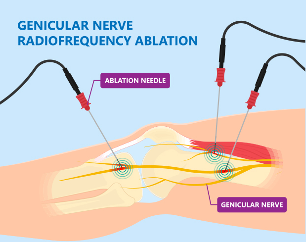 radiofrequency ablation
