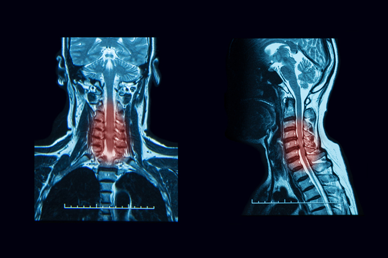 Cervical Spinal Stenosis - The Orthopedic Pain Institute, Beverly Hills  Pain Management Specialist