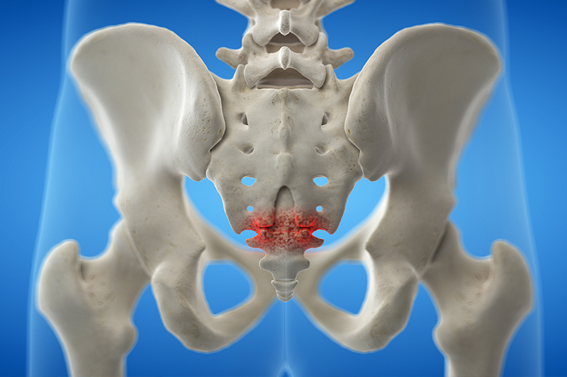 🥇 NYC Coccydynia (Tailbone Pain) Treatment, Causes