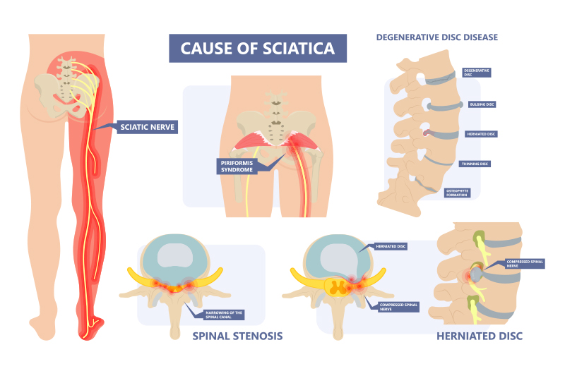 Piriformis Syndrome: Symptoms, Causes & More